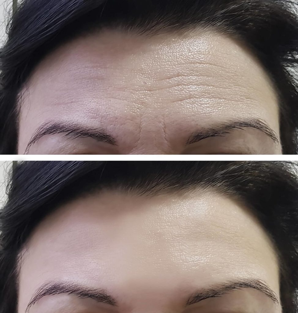forehead-women-wrinkles-before-and-after