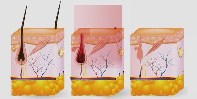 lasersko-odstranjevanje-dlak