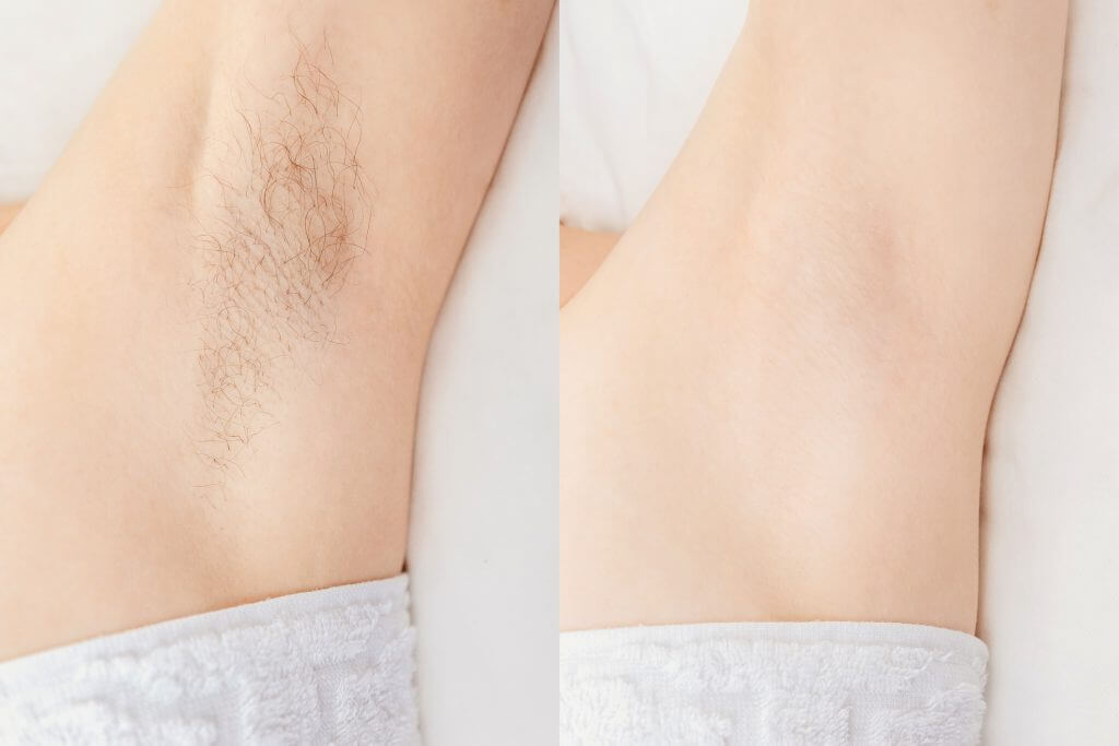 lasersko-odstranjevanje-dlak4