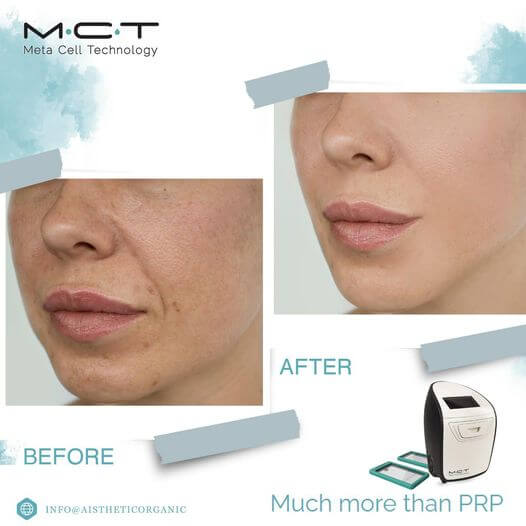 mct-before-after