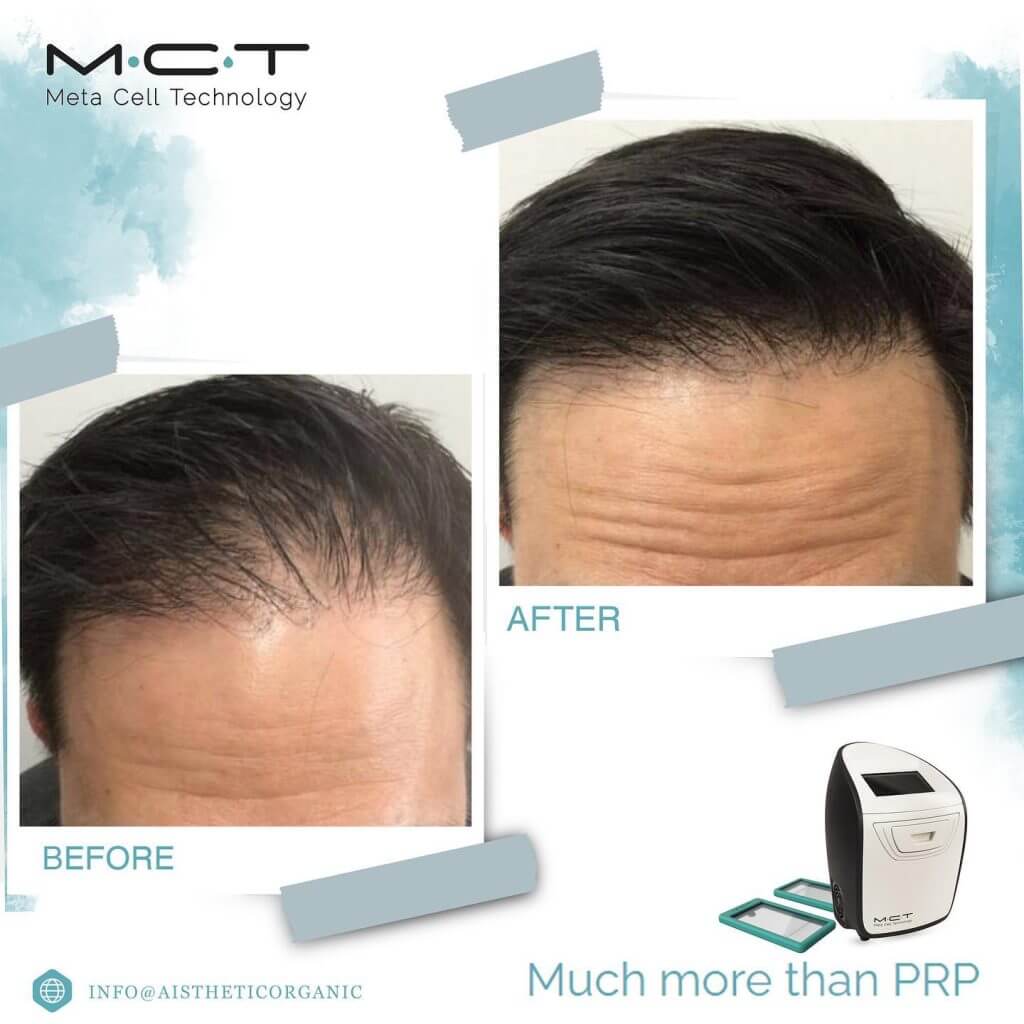 mct-estetika-male-lasišče