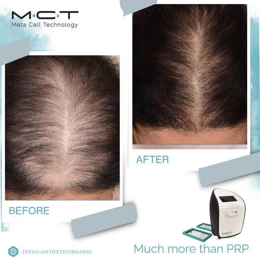 mct-hair-before-after