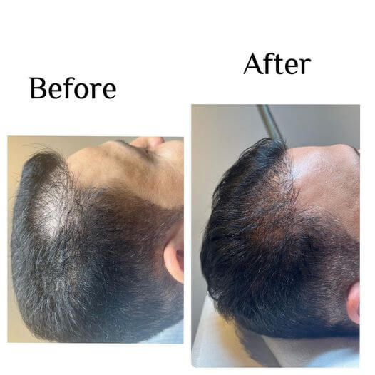 mct-lasišče-moški