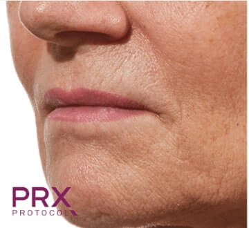 prx-protocol-2