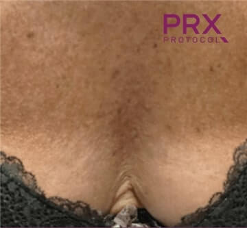 prx-protocol-4