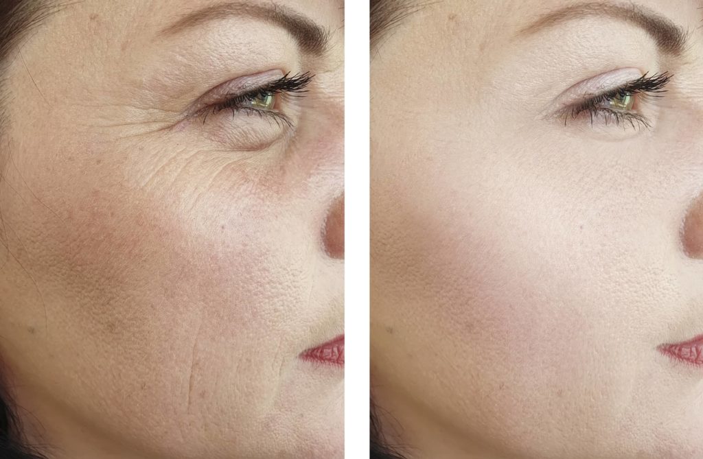 woman-wrinkles-face-beautician-effect-therapydifference-regeneration-before-and-after-treatments